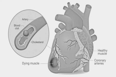 হার্ট ব্লকের চিকিৎসা পদ্ধতি