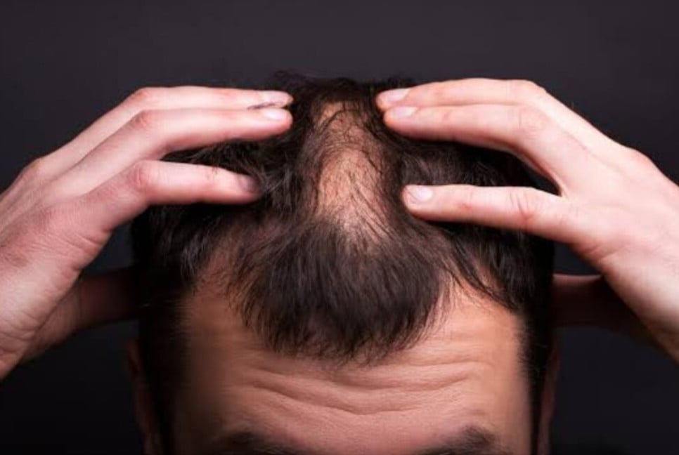 টাক সমস্যার সমাধান, ৩০ বছর পর মিলল নতুন ওষুধ