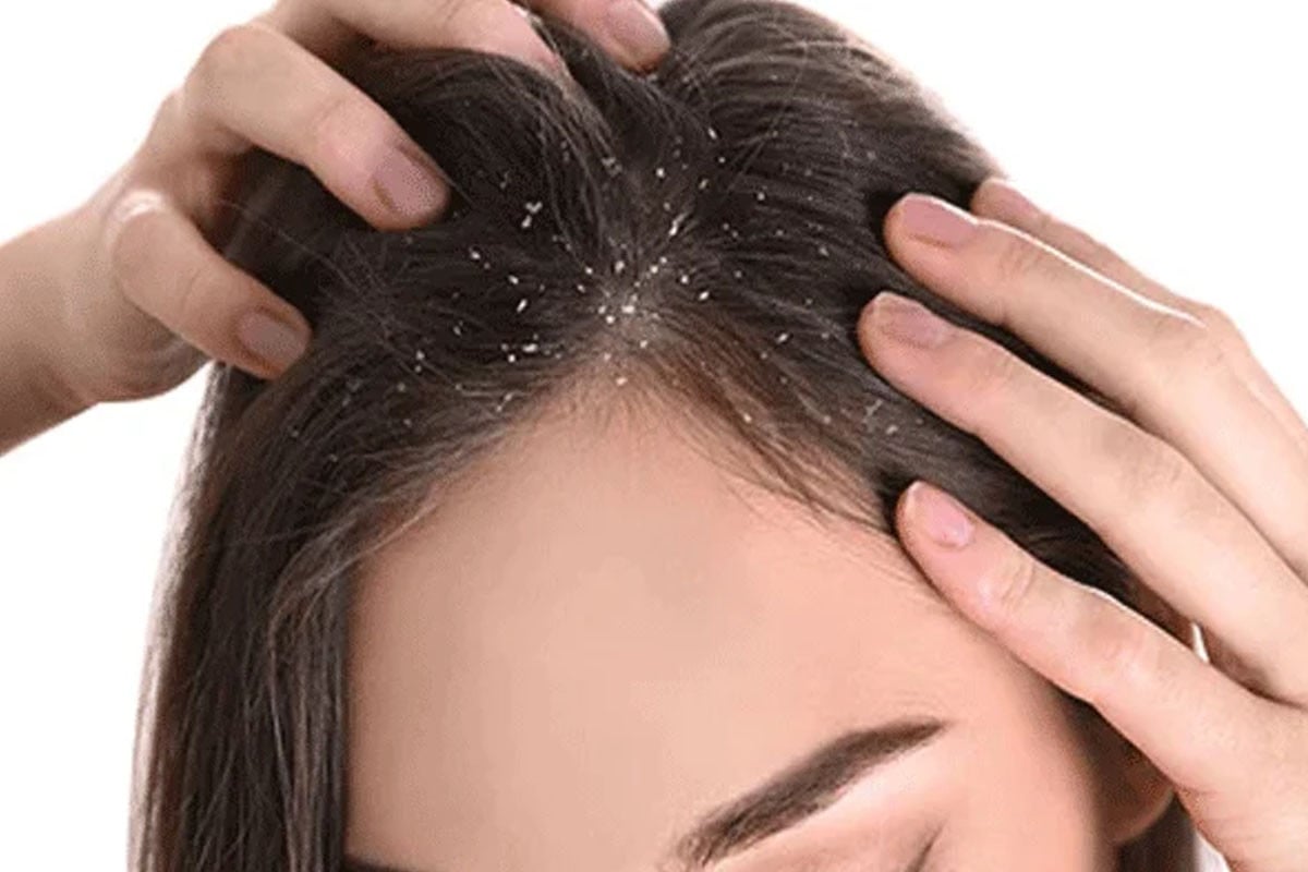 শীতে খুশকি রোধে ঘরোয়া উপায়