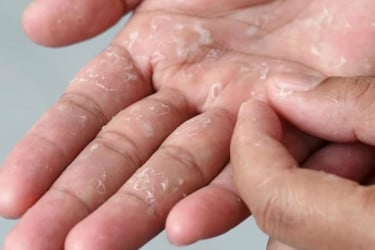 শীতকালে হাতের চামড়া ওঠার সমস্যা: প্রতিকার কী?