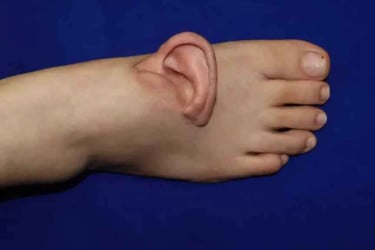 প্রথমবারের মতো বিচ্ছিন্ন কান পায়ে প্রতিস্থাপন, আবার যথাস্থানে স্থাপন