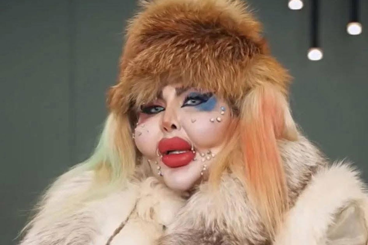 চেহারা সুন্দর করতে ৩৮৮ বার প্লাস্টিক সার্জারি, খরচ ৬০০ কোটি টাকা