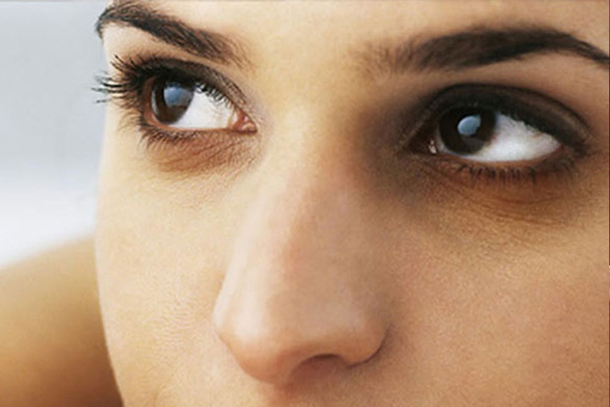 চোখের নিচে কালো দাগ!