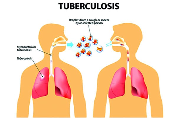 যক্ষ্মার উপসর্গ ও করণীয়