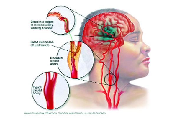 স্ট্রোক-পরবর্তী জটিলতা ও চিকিৎসা