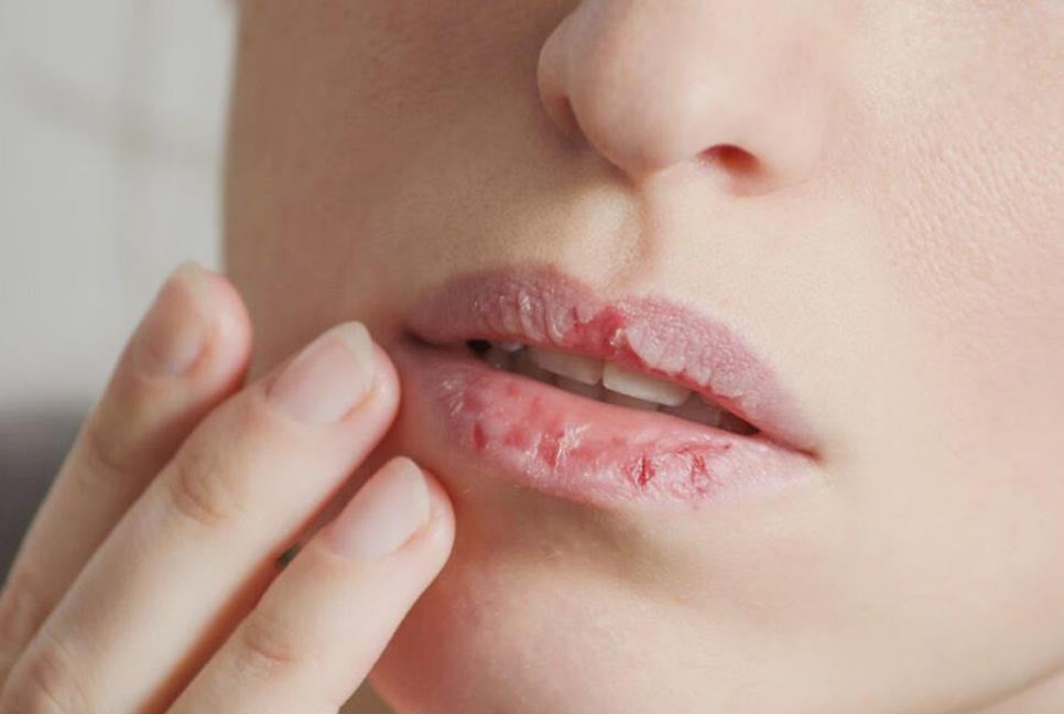 গরমেও ফাটছে ঠোঁট, প্রতিকার কী
