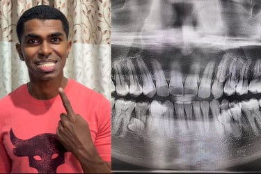 ৪২টি দাঁত নিয়ে গিনেস রেকর্ড গড়লেন মালয়েশিয়ার ব্যক্তি