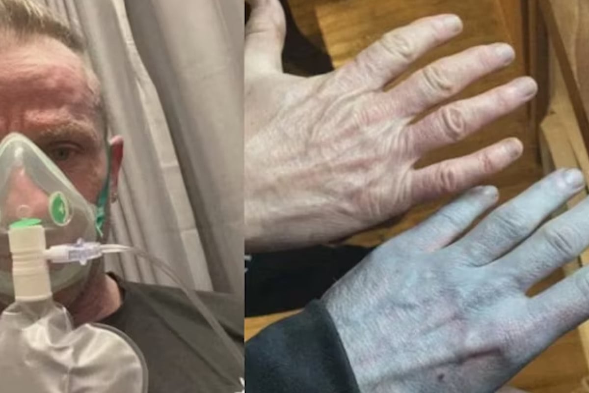 ঘুম ভেঙে দেখলেন পুরো শরীর অ্যাভাটারের মতো নীল, আতঙ্কে হাসপাতালে; তারপর যা ঘটল...