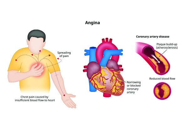ক্ষণিকের ব্যথা এনজিনা