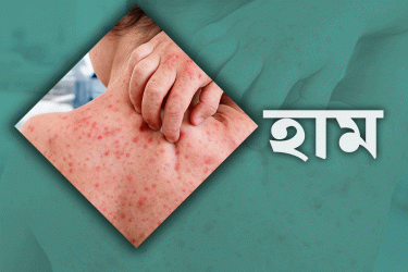 খুলনায় হামের উপসর্গ নিয়ে আরও এক শিশুর মৃত্যু