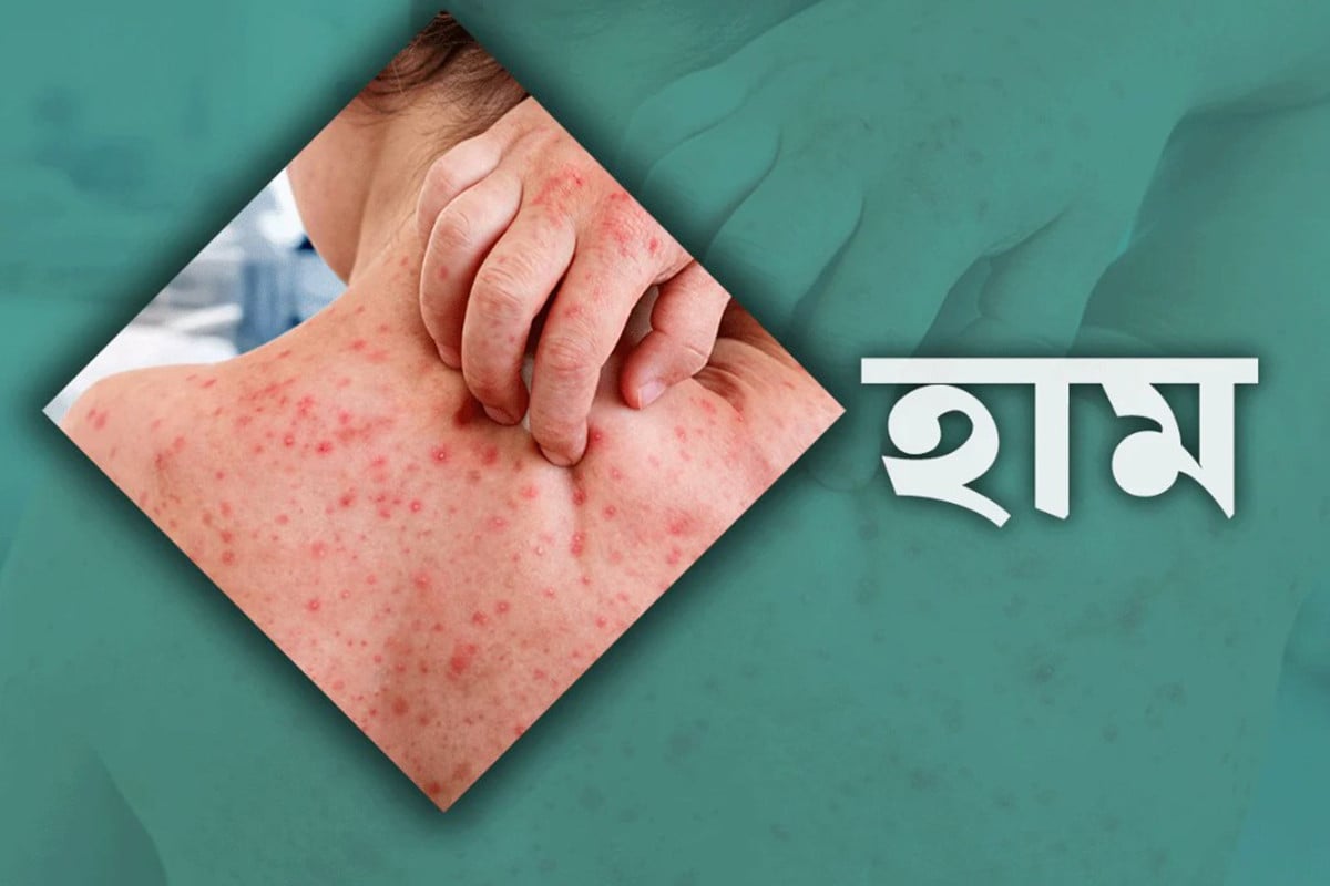 ঢাকাসহ ৪ সিটিতে হামের টিকা দেওয়া হবে আজ