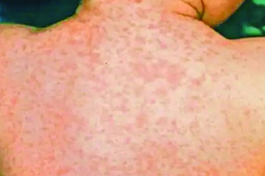 হাম ও উপসর্গে আরও পাঁচ শিশুর মৃত্যু