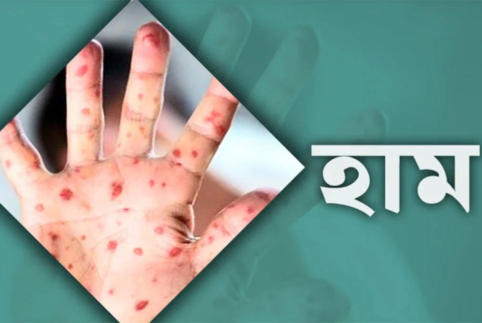 সিলেটে বেড়েই চলছে হামের প্রকোপ