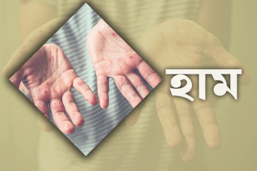 কুমিল্লায় হাম উপসর্গে আরও এক শিশুর মৃত্যু