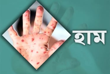 ২৪ ঘণ্টায় হাম উপসর্গে আরও ৫ জনের মৃত্যু