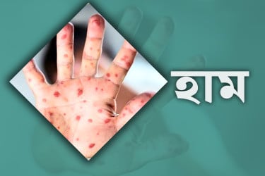 হাম উপসর্গ নিয়ে ২৪ ঘণ্টায় আরও ৩ শিশুর মৃত্যু