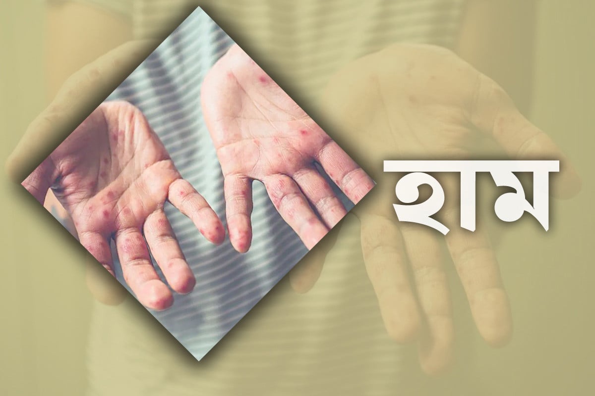 হাম উপসর্গে একদিনে আরও ৫ জনের মৃত্যু