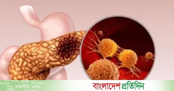 অগ্ন্যাশয় ক্যান্সারের যুগান্তকারী ওষুধের অনুমোদন দিল যুক্তরাষ্ট্র - bd