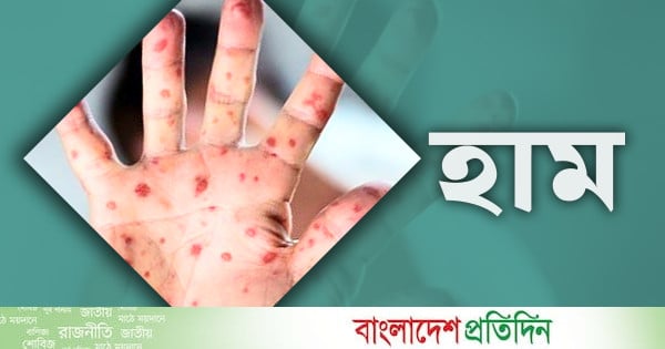 হাম উপসর্গে আরও ৫ শিশুর মৃত্যু - bd